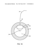 SYSTEM AND METHOD FOR VESSEL ACCESS CLOSURE diagram and image