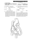 SEPTAL DEFECT CLOSURE DEVICE diagram and image