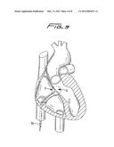 SEPTAL DEFECT CLOSURE DEVICE diagram and image