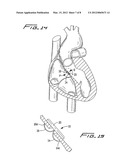 SEPTAL DEFECT CLOSURE DEVICE diagram and image