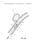 SYSTEM AND METHOD FOR MECHANICALLY POSITIONING INTRAVASCULAR IMPLANTS diagram and image