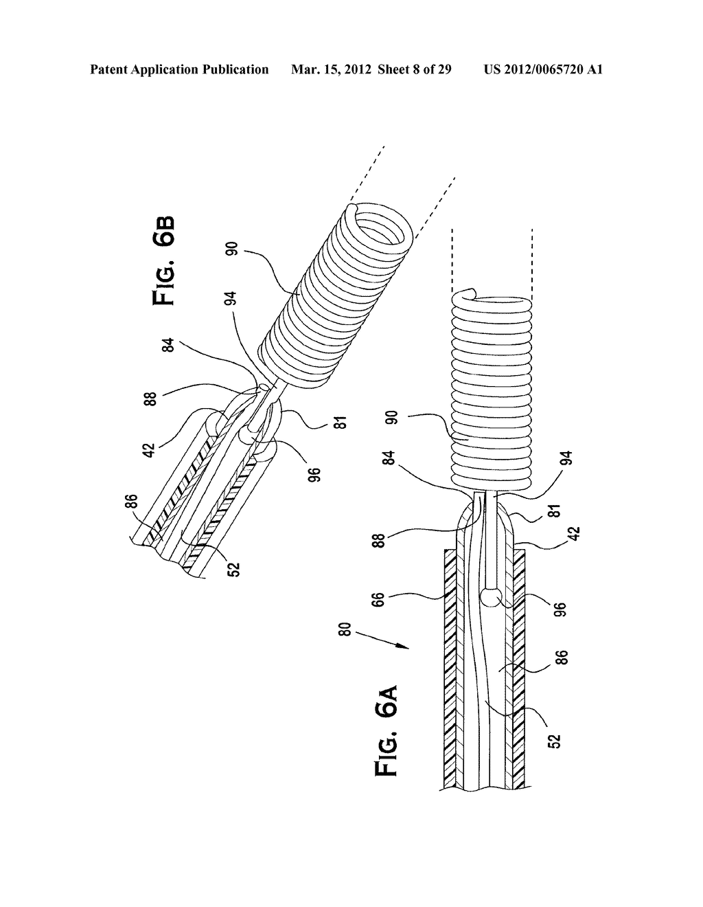 SYSTEM AND METHOD FOR MECHANICALLY POSITIONING INTRAVASCULAR IMPLANTS - diagram, schematic, and image 09