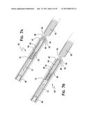 SYSTEM AND METHOD FOR MECHANICALLY POSITIONING INTRAVASCULAR IMPLANTS diagram and image