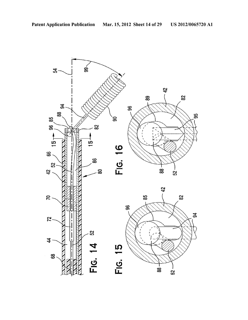 SYSTEM AND METHOD FOR MECHANICALLY POSITIONING INTRAVASCULAR IMPLANTS - diagram, schematic, and image 15