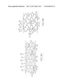 Intravascular Stent diagram and image