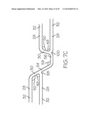 Intravascular Stent diagram and image