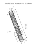 Intravascular Stent diagram and image