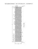 Intravascular Stent diagram and image