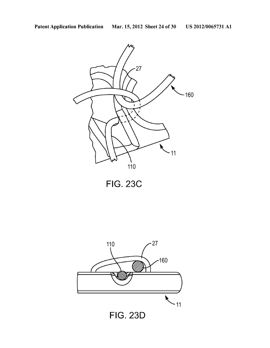 SYSTEMS AND METHODS FOR INTRA-OPERATIVE TENSION AND FIXATION OF ZIPKNOT     ACL FIXATION - diagram, schematic, and image 25