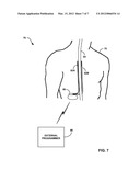 POWER SOURCE COUPLING AND DECOUPLING IN MEDICAL DEVICE diagram and image