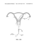 METHODS, SYSTEMS AND DEVICES FOR PERFORMING GYNECOLOGICAL PROCEDURES diagram and image