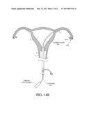 METHODS, SYSTEMS AND DEVICES FOR PERFORMING GYNECOLOGICAL PROCEDURES diagram and image