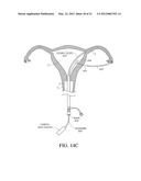 METHODS, SYSTEMS AND DEVICES FOR PERFORMING GYNECOLOGICAL PROCEDURES diagram and image