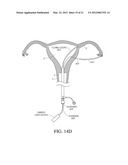 METHODS, SYSTEMS AND DEVICES FOR PERFORMING GYNECOLOGICAL PROCEDURES diagram and image