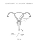 METHODS, SYSTEMS AND DEVICES FOR PERFORMING GYNECOLOGICAL PROCEDURES diagram and image