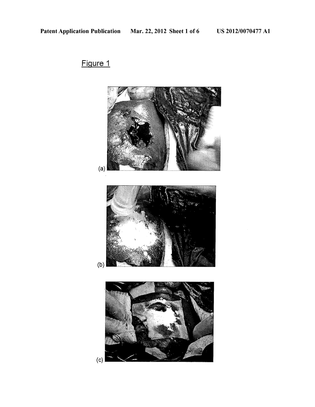 DRY POWDER FIBRIN SEALANT - diagram, schematic, and image 02