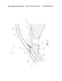 OCULAR IMPLANT SYSTEMS diagram and image