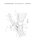 OCULAR IMPLANT SYSTEMS diagram and image