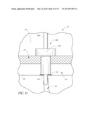 OCULAR IMPLANT SYSTEMS diagram and image