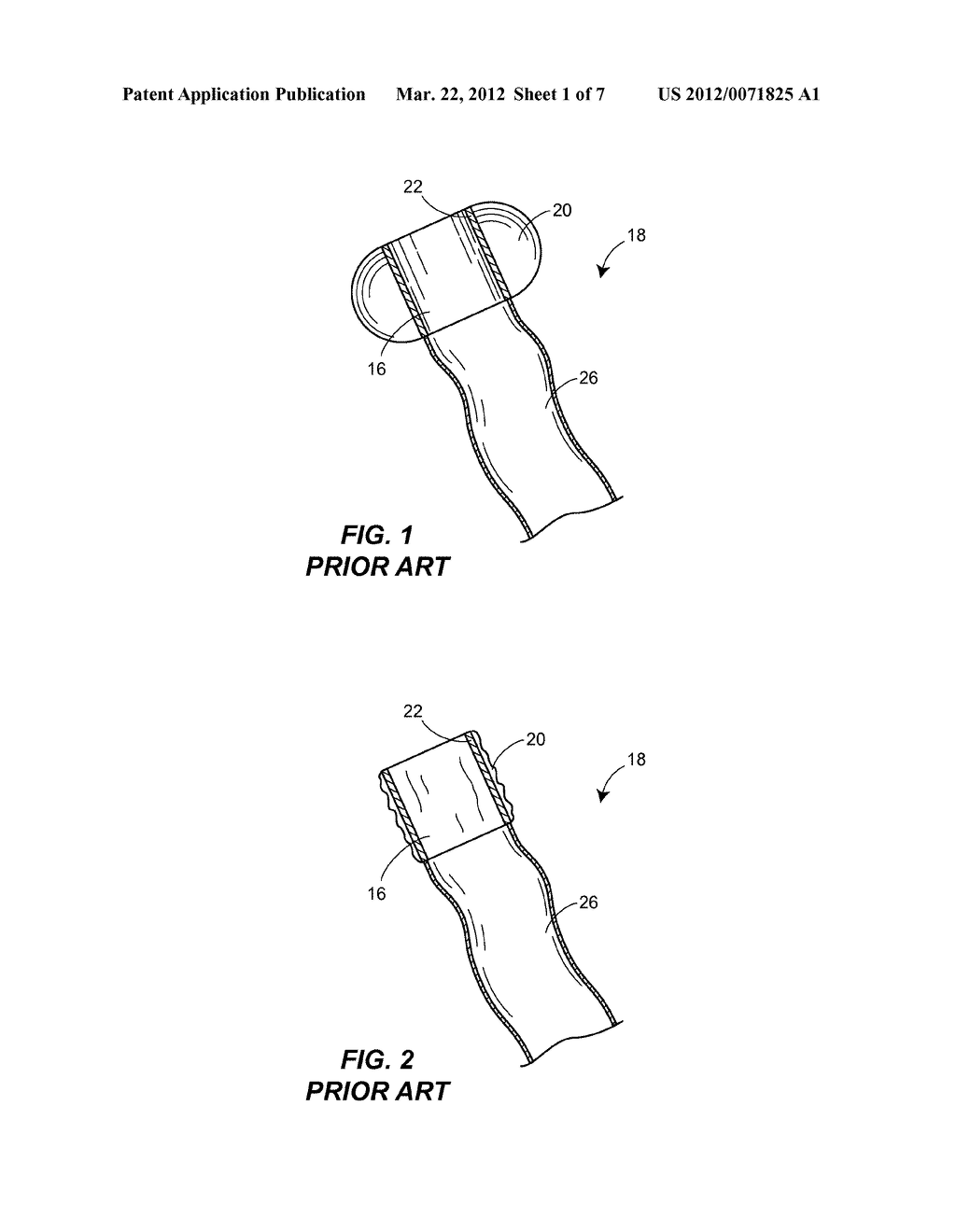 SOLUBLE MATERIAL INSERTION AID FOR BALLOON CATHETER - diagram, schematic, and image 02