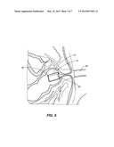 SOLUBLE MATERIAL INSERTION AID FOR BALLOON CATHETER diagram and image