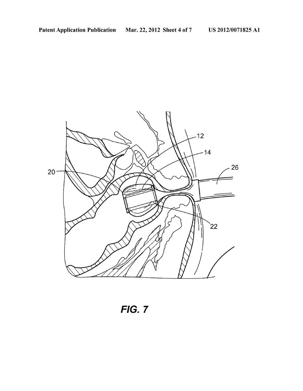 SOLUBLE MATERIAL INSERTION AID FOR BALLOON CATHETER - diagram, schematic, and image 05