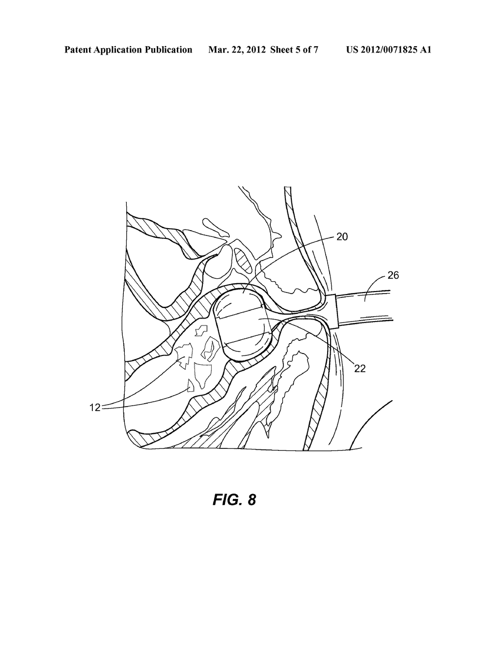 SOLUBLE MATERIAL INSERTION AID FOR BALLOON CATHETER - diagram, schematic, and image 06