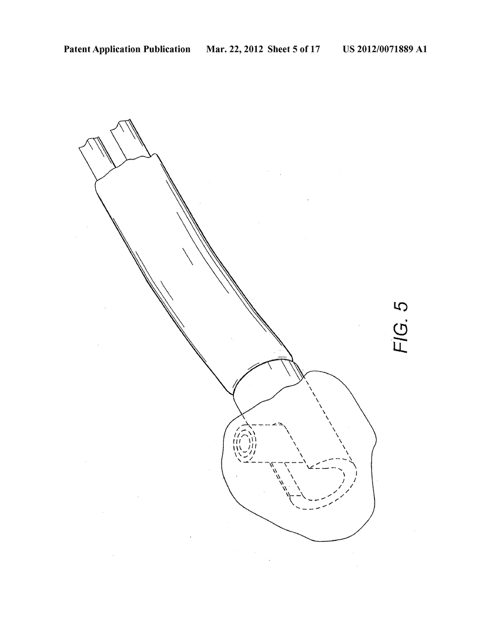 RADIALLY-FIRING ELECTROHYDRAULIC LITHOTRIPSY PROBE - diagram, schematic, and image 06