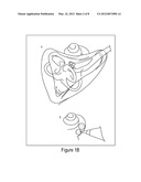 METHOD AND APPARTUS FOR COCHLEAR IMPLANT SURGERY diagram and image