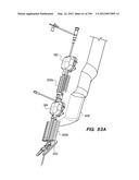 ANTI-BUCKLING MECHANISMS AND METHODS diagram and image