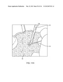 SYSTEM FOR PROVIDING SURGICAL ACCESS diagram and image