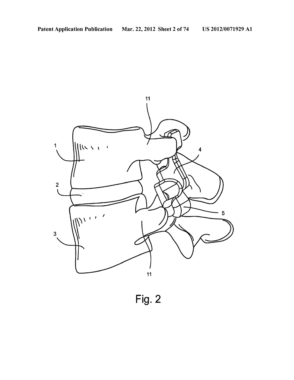 Linked Bilateral Spinal Facet Implants and Methods of Use - diagram, schematic, and image 03