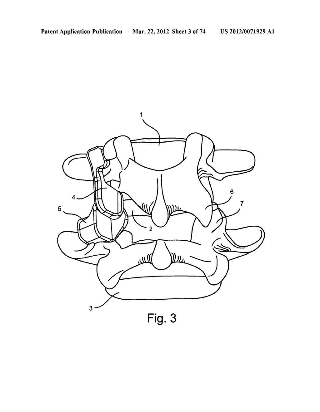 Linked Bilateral Spinal Facet Implants and Methods of Use - diagram, schematic, and image 04