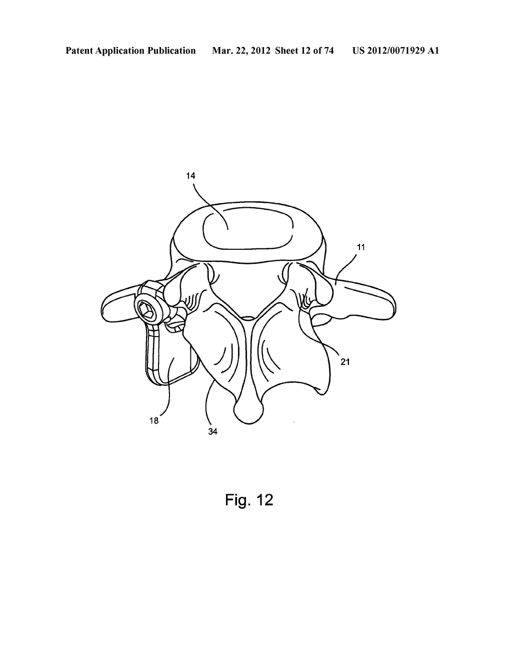 Linked Bilateral Spinal Facet Implants and Methods of Use - diagram, schematic, and image 13