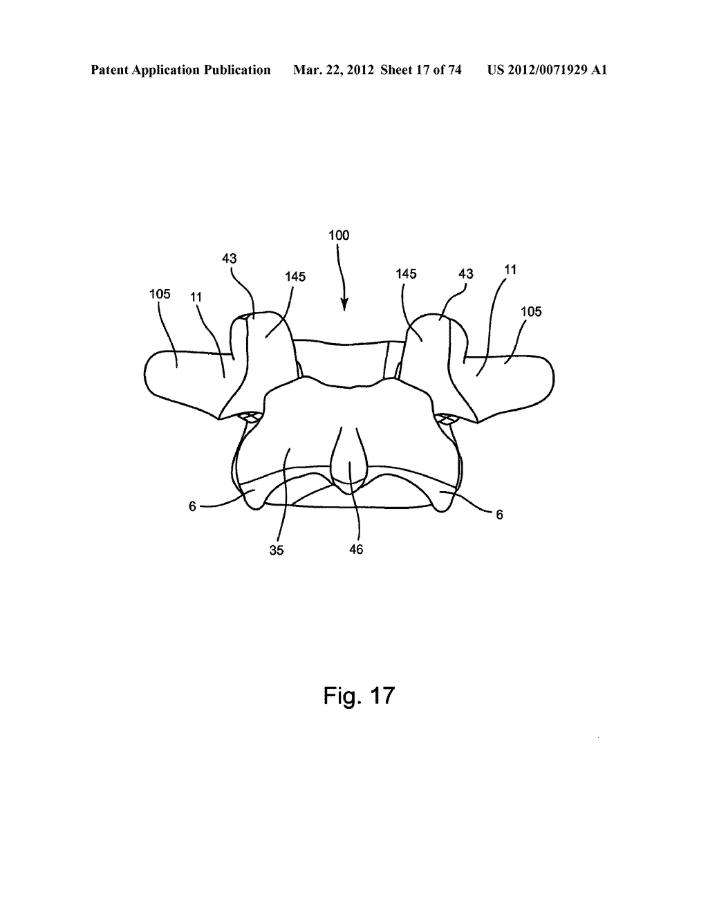 Linked Bilateral Spinal Facet Implants and Methods of Use - diagram, schematic, and image 18