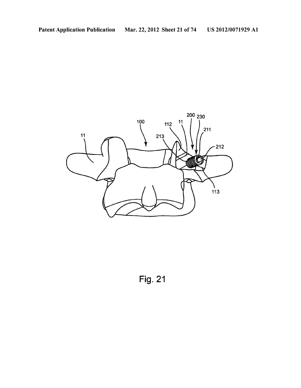 Linked Bilateral Spinal Facet Implants and Methods of Use - diagram, schematic, and image 22