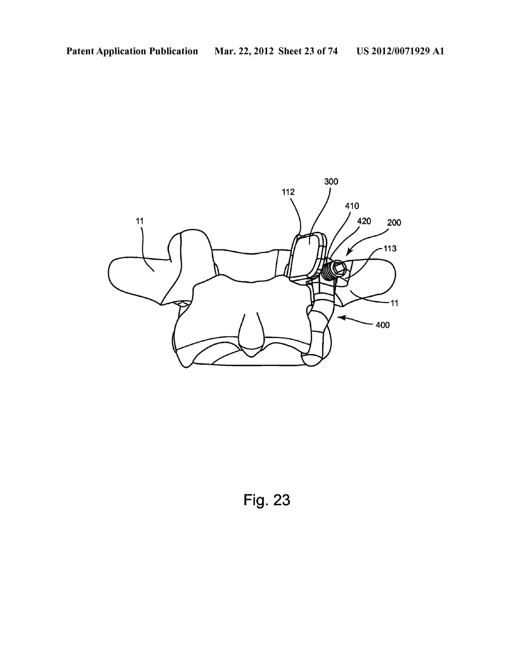 Linked Bilateral Spinal Facet Implants and Methods of Use - diagram, schematic, and image 24