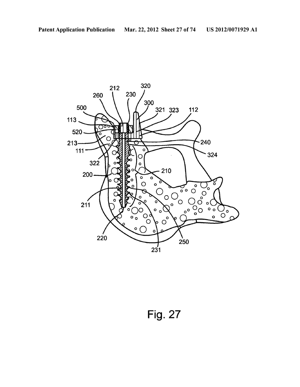 Linked Bilateral Spinal Facet Implants and Methods of Use - diagram, schematic, and image 28