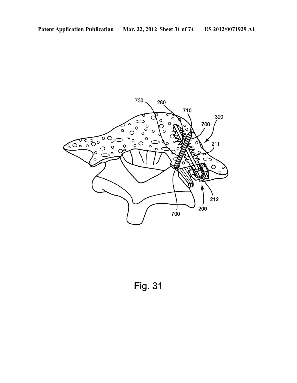 Linked Bilateral Spinal Facet Implants and Methods of Use - diagram, schematic, and image 32