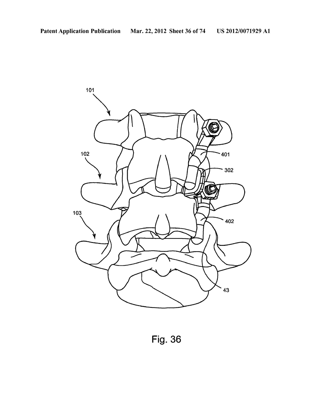 Linked Bilateral Spinal Facet Implants and Methods of Use - diagram, schematic, and image 37