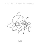 Linked Bilateral Spinal Facet Implants and Methods of Use diagram and image