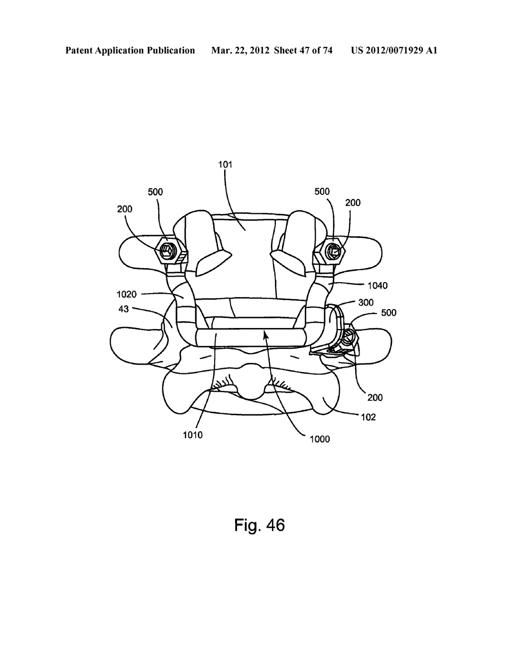 Linked Bilateral Spinal Facet Implants and Methods of Use - diagram, schematic, and image 48