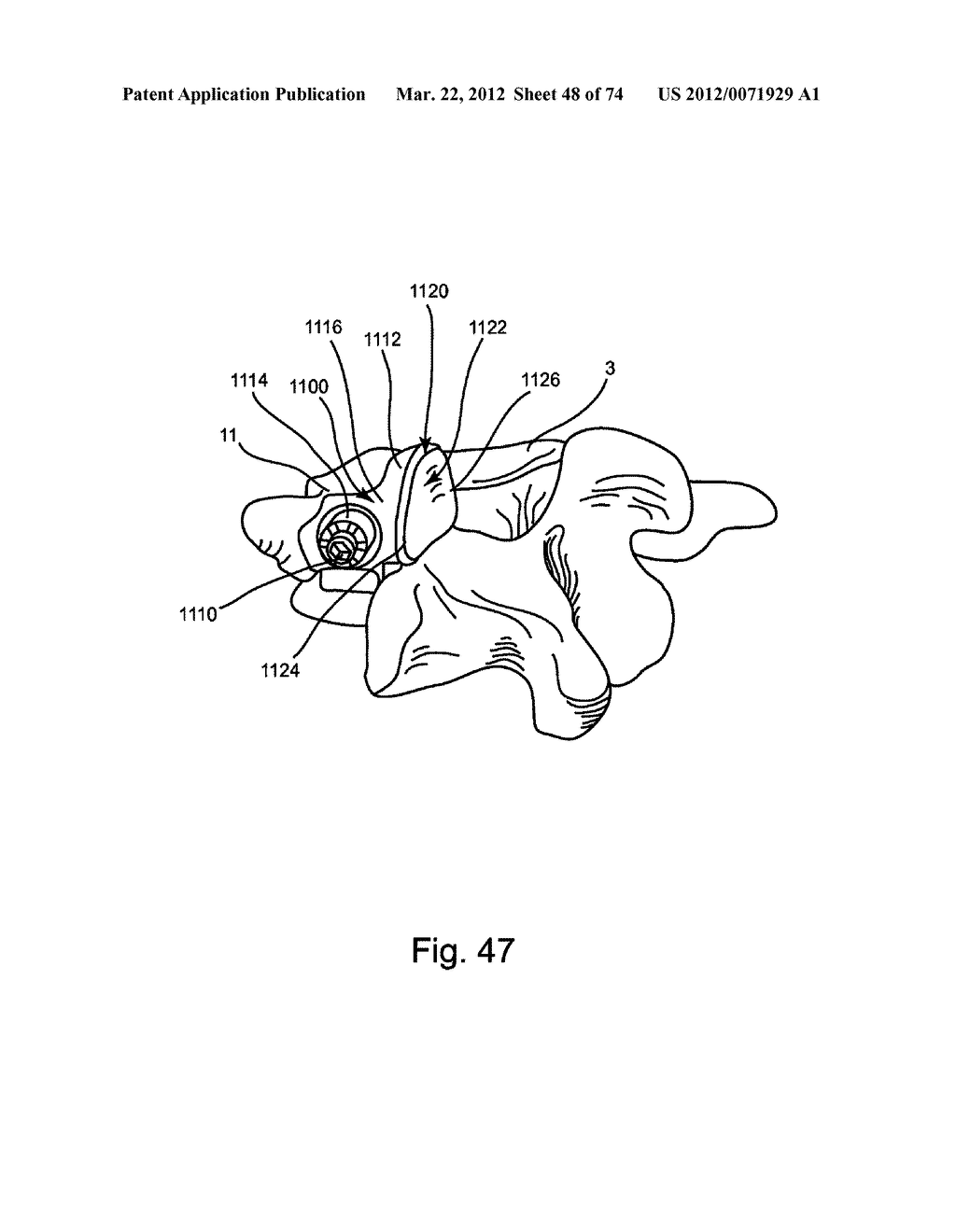 Linked Bilateral Spinal Facet Implants and Methods of Use - diagram, schematic, and image 49