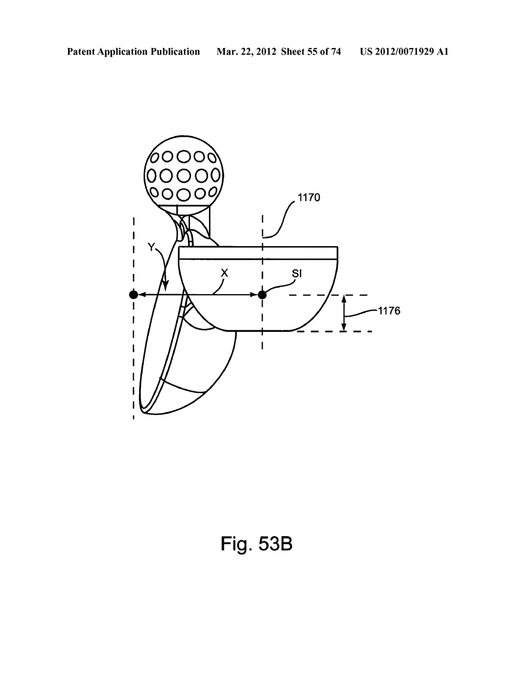 Linked Bilateral Spinal Facet Implants and Methods of Use - diagram, schematic, and image 56