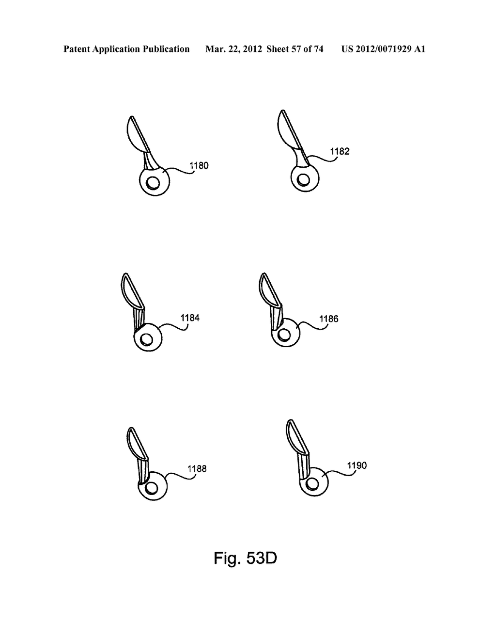 Linked Bilateral Spinal Facet Implants and Methods of Use - diagram, schematic, and image 58