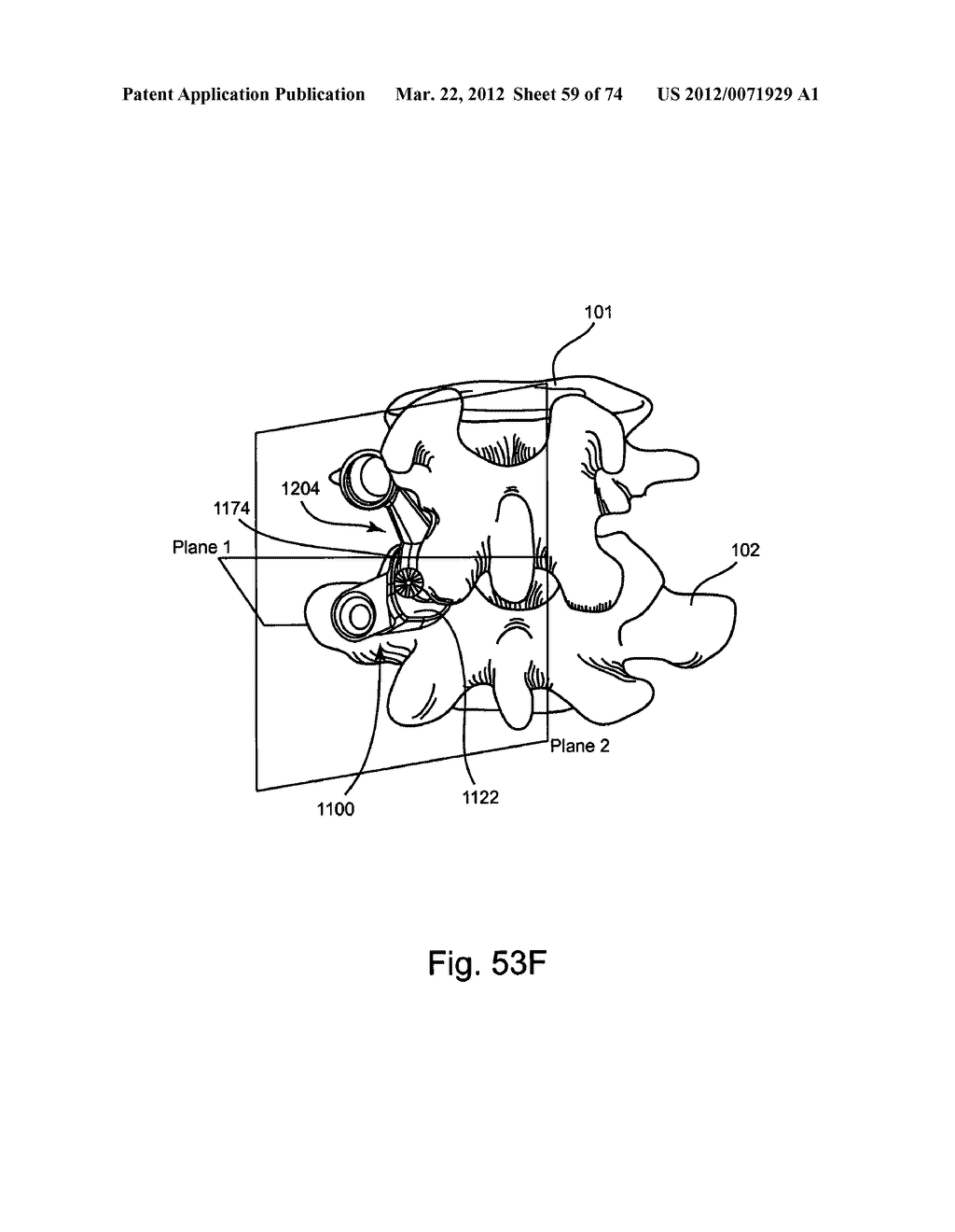 Linked Bilateral Spinal Facet Implants and Methods of Use - diagram, schematic, and image 60