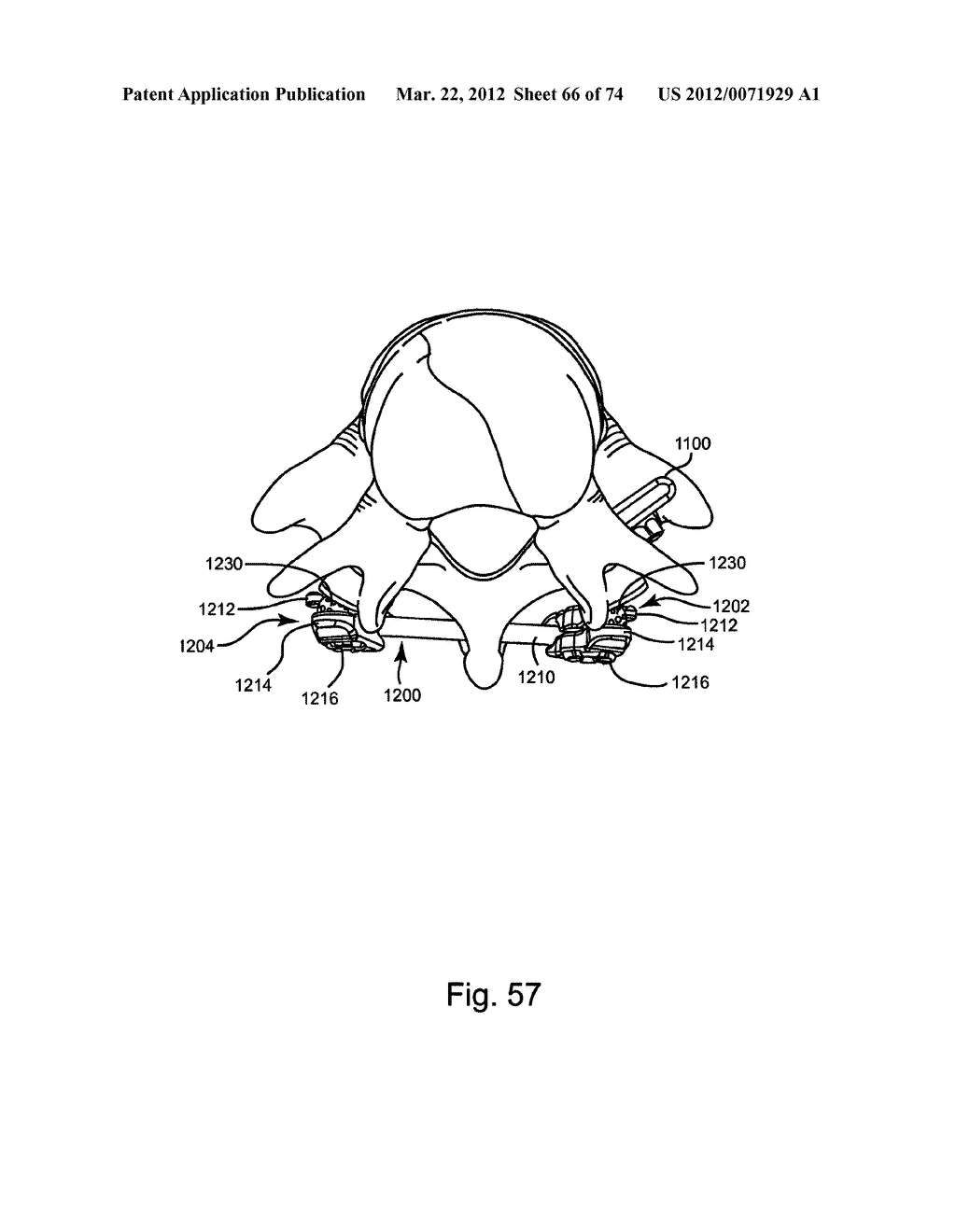 Linked Bilateral Spinal Facet Implants and Methods of Use - diagram, schematic, and image 67