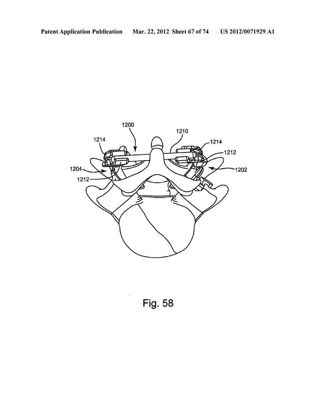 Linked Bilateral Spinal Facet Implants and Methods of Use - diagram, schematic, and image 68