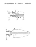 PEDICLE SCREW ASSEMBLY AND METHODS THEREFOR diagram and image