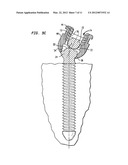 PEDICLE SCREW ASSEMBLY AND METHODS THEREFOR diagram and image